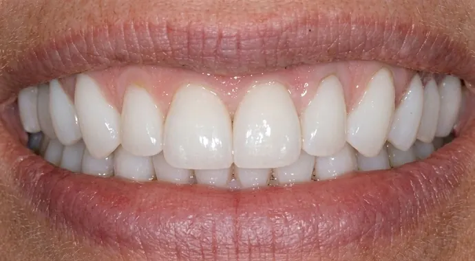 After: the same smile with even, bright veneers.