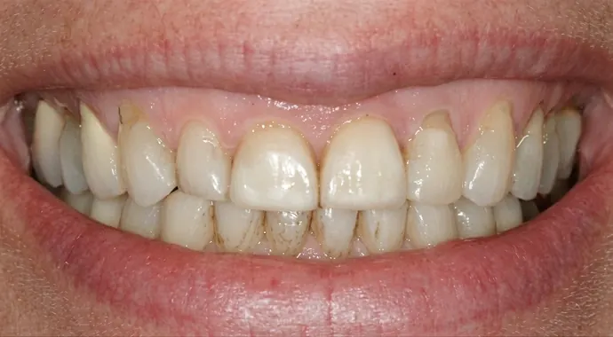 Before: a worn, uneven row of front teeth.