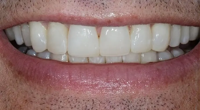After: the same teeth evened out with bonding.
