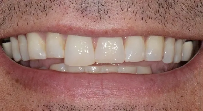 Before: front teeth with chips and uneven edges.