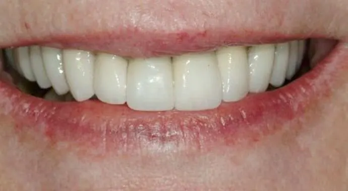 After: a uniform, restored smile.