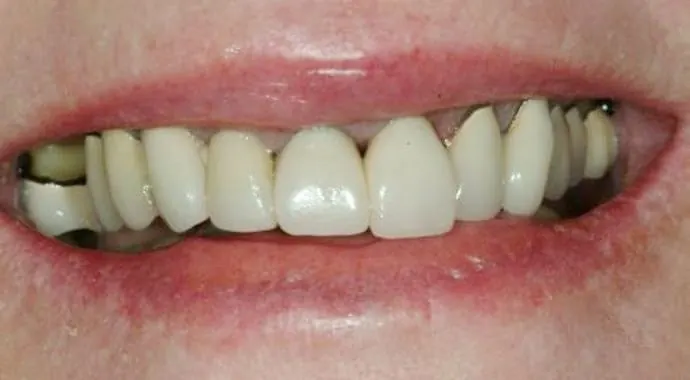 Before: mismatched older restorations across the front teeth.